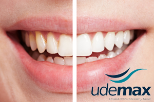 blanqueamiento dental mallorca